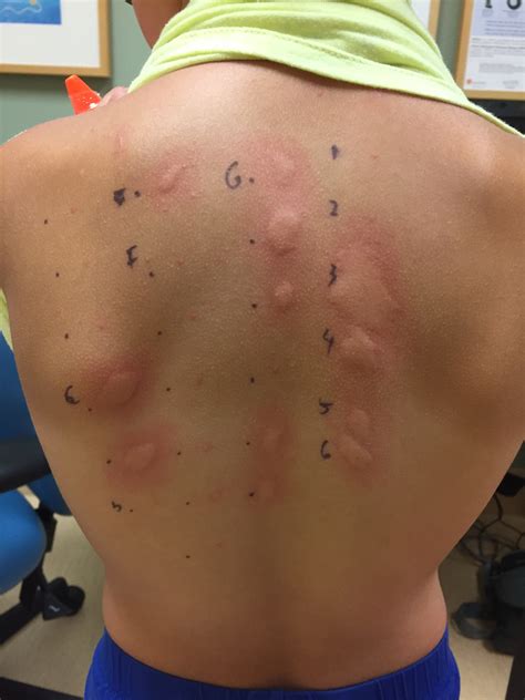 scratch test for allergy|allergy scratch test on back.